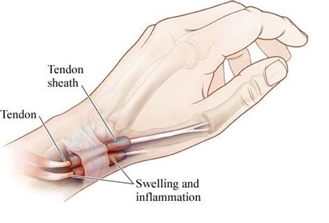 De quervain tenosynovitis is commonly seen in patients who perform repetitive wrist ulnar deviation with thumb abduction and extension. Quervain Tenosynovitis, otherwise known as De Quervain ...
