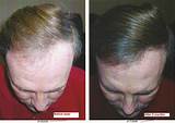 Hair Loss Treatment Chicago