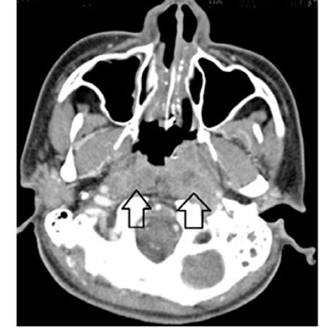 A Axial Ct Picture Showing Multiple Enlarged Cervical Submandibular
