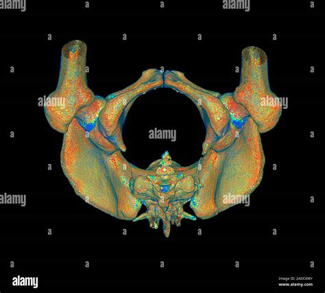 Female Pelvis Digitally Enhanced 3d Computed Tomography Ct Scan Of