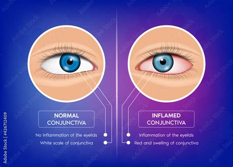 Normal Conjunctiva And Conjunctivitis Healthy Eye And Pink Eye Most