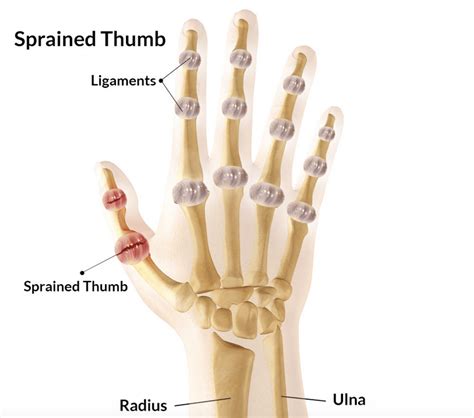 Sprained Thumb Symptoms Treatment Rehabilitation And Taping