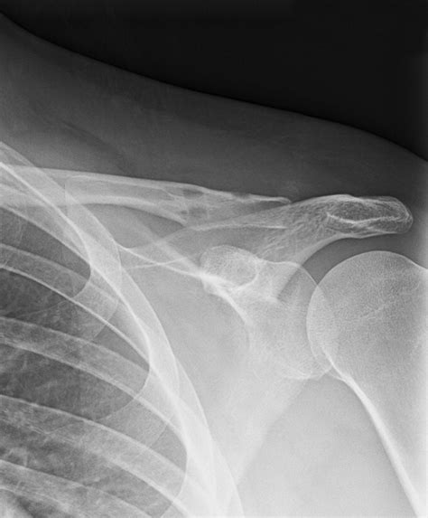 Acromioclavicular Joint The Other Joint In The Shoulder Ajr