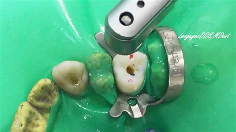 Maxillary First Premolar Access Cavity Preparation Endodontic Youtube