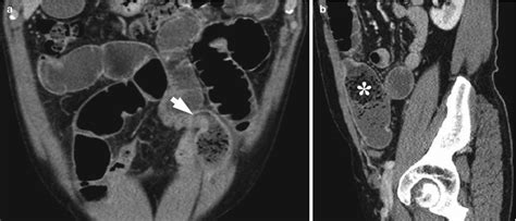 Small Bowel Obstruction Radiology Key