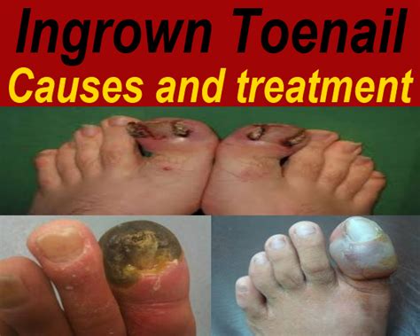 1 Of Th Best Of Ingrown Toenail Causes And Treatment
