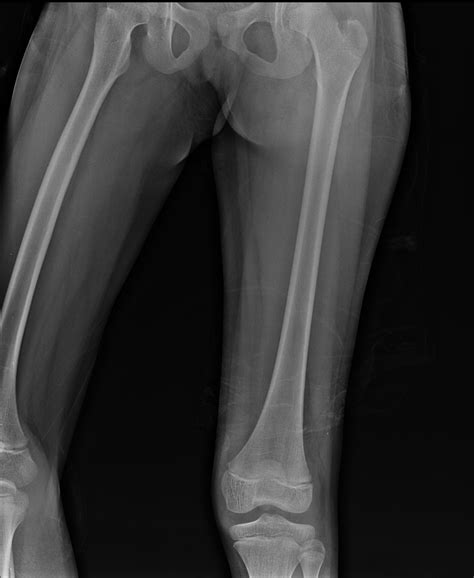 Subperiosteal abscess of femur | Image | Radiopaedia.org