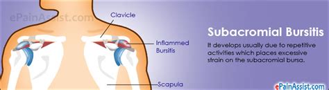 Subacromial Bursitis Treatment Exercise Causes Symptoms The Best Porn