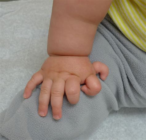 Difficult Extra Thumbs Congenital Hand And Arm Differences Washington University In St Louis