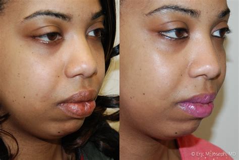 Lips Reduction Surgery Before And After Lipstutorial Org