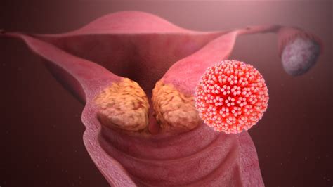 Síntomas Del Virus Del Papiloma Humano A Los Que Debes Prestar Atención