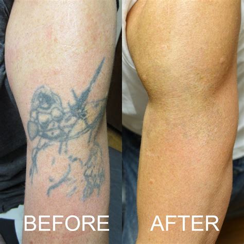 Tattoo Removal Beforeafter Before And After Photos