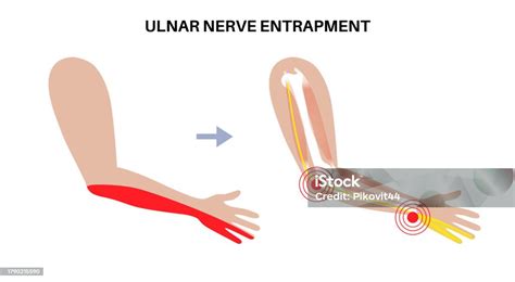 Ulnar Nerve Entrapment Stock Illustration Download Image Now Arm