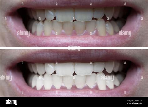 Teeth Whitening Before After Stock Photo Alamy