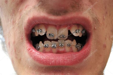 Close Up Of Crooked Teeth With Braces — Stock Photo © Vlue 4626241