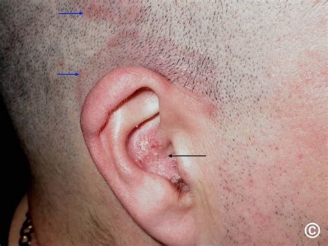 Plaque Psoriasis Ear