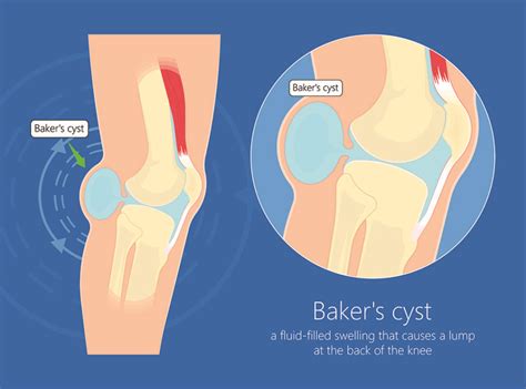 Popliteal Or Bakers Cyst Overview Town Center Orthopaedics