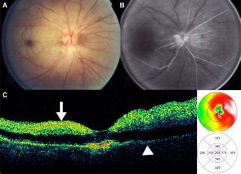 Central Retinal Artery Occlusion Notes A Color Fundus Photograph