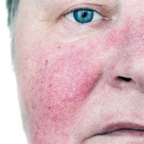 Telangiectasia And Rosacea Spot Check Clinic
