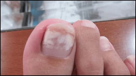 What Causes White Spots On My Toenails Design Talk