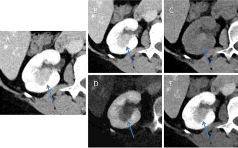 Dual Energy Mixed Kv Contrast Enhanced Ct Images From The