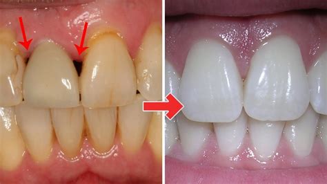 3 Ridiculously Easy Ways To Treat Gum Disease At Home Youtube