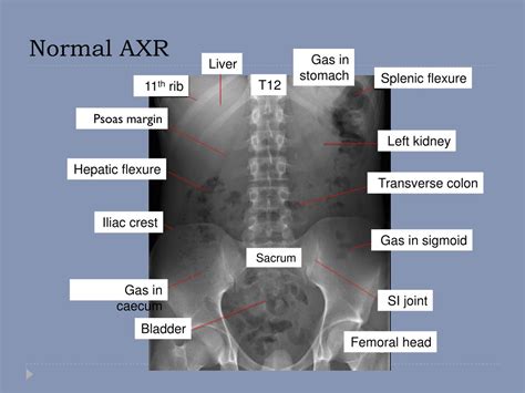 Ppt Radiology Of The Abdomen Powerpoint Presentation Free Download