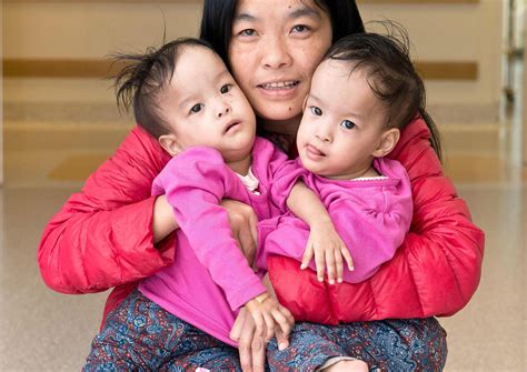 conjoined bhutanese twins undergo separation surgery health asia news