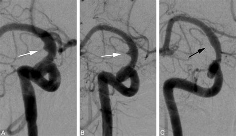 Fig 2 The Efficacy Of Endovascular Stenting In The Treatment Of