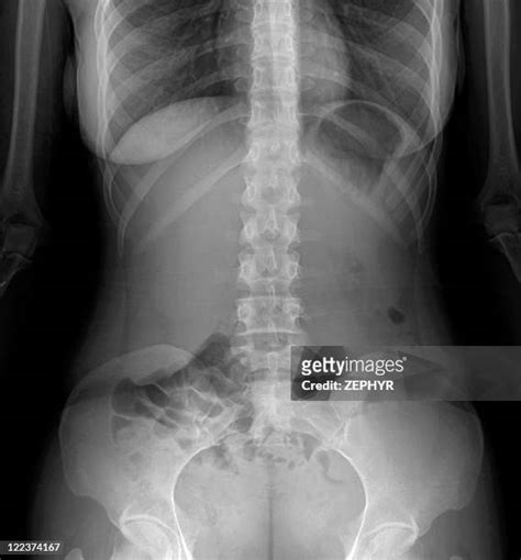 X Ray Abdomen Photos And Premium High Res Pictures Getty Images