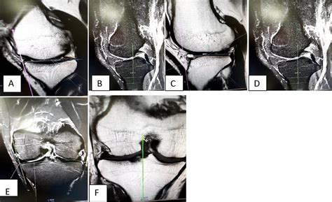 Measurement Of Tibial Slops A Showing The Medial Posterior Tibial