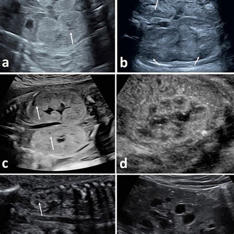 Prenatal Ultrasound In Autosomal Recessive Polycystic Kidney Disease