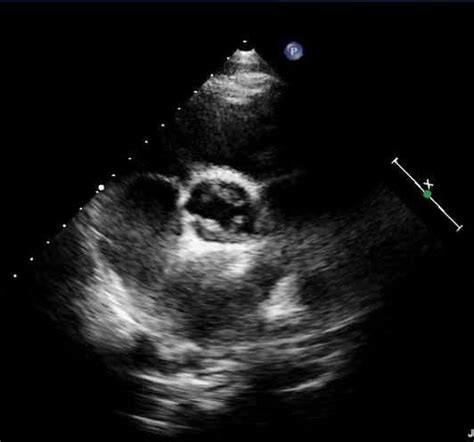 A Preoperative Echocardiography Showing Quadricuspid Aortic Valve With