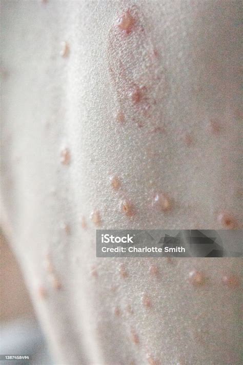 Chickenpox Vesicle Blisters On A Birthmark On A Childs Back Stock Photo