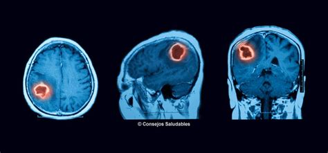 Tumor Cerebral Qué Es Síntomas Y Causa