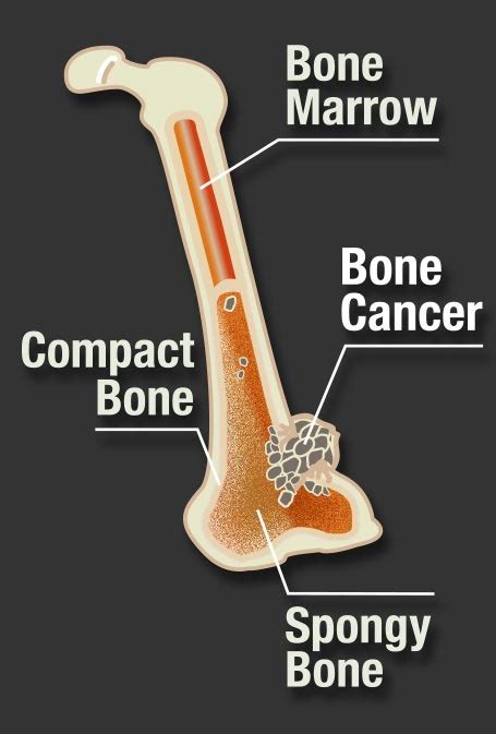 Learn how bone cancer is diagnosed and treated. Bone & Multiple Myeloma Cancer Facts & Symptoms | UHC Oncology