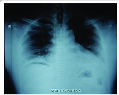 Erect Chest X Ray Showing Free Air Under The Right Diaphragm