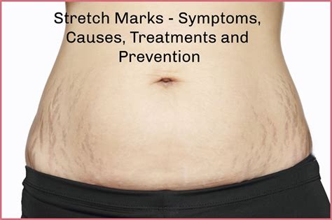 Stretch Marks Symptoms Causes Treatments And Prevention Eeva