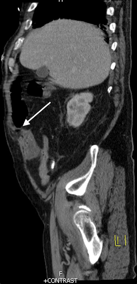 Figure 1 From An Unusual Presentation Of Spigelian Hernia Incarceration