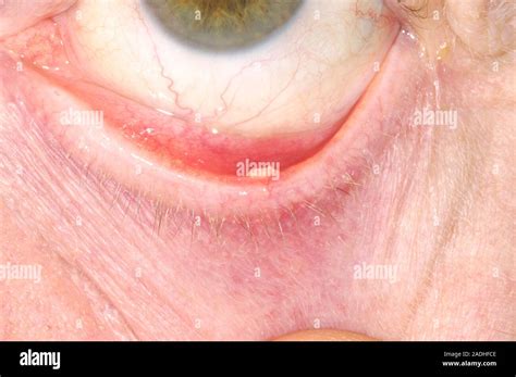 Eye Cyst Centre On The Lower Eyelid Of A 72 Year Old Man This Is A