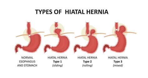 Hiatal Hernia After Gastric Bypass What It Is Complications Options