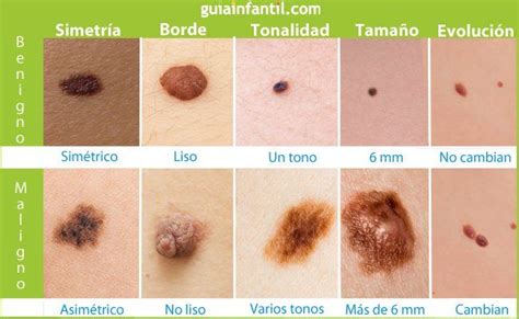 Guía Para Identificar Si Los Lunares De Tu Hijo Son Cancerosos