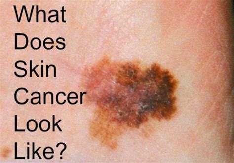 Do You Know What Skin Cancer Looks Like Bath And Body