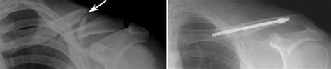 Clavicle Fracture Broken Collarbone Orthoinfo Aaos