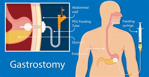 Gastrostomy Feeding