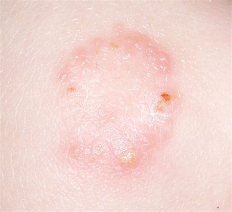Baby Rashes That Look Like Ringworm Images And Photos Finder