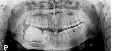 Panoramic Radiograph Shows The Lesion As A Well Defined Radiopacity
