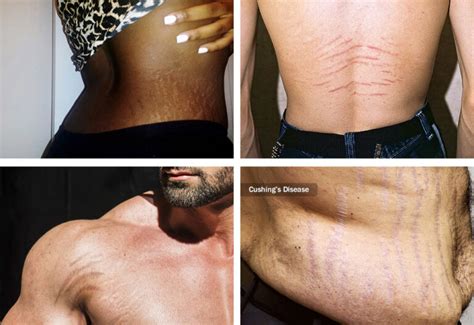 Brazilian Stretch Mark And Scar Camouflage Tattooing Ink Illusions