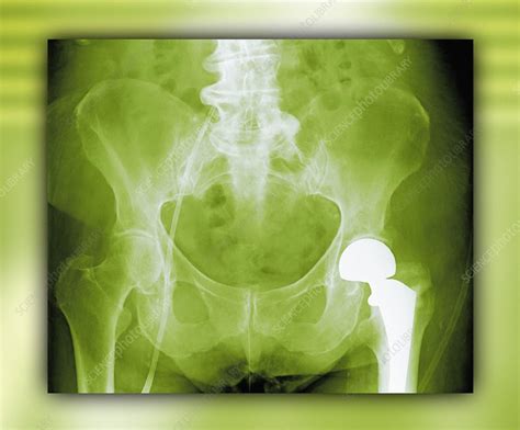 Total Hip Replacement X Ray Stock Image F001 2994 Science Photo Library