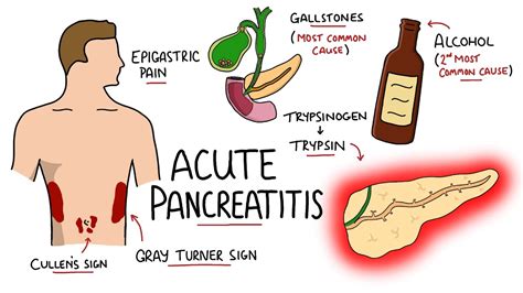 Acute Pancreatitis Causes Signs And Symptoms Pathophysiology